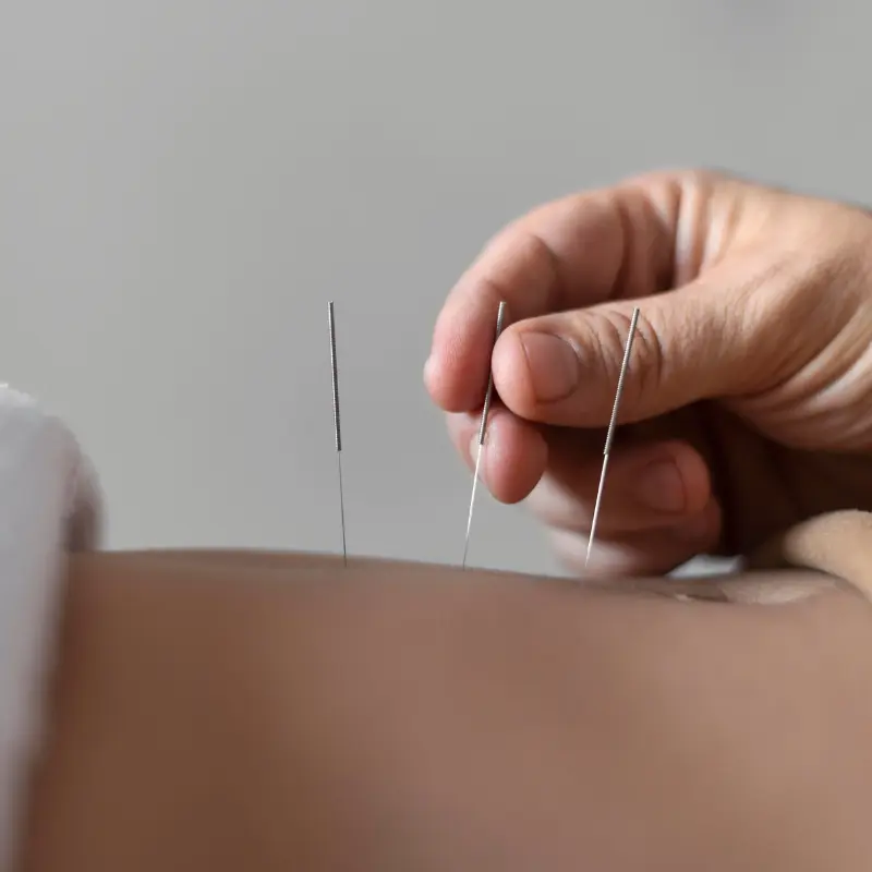 Agulhamento Seco (Dry Needling)